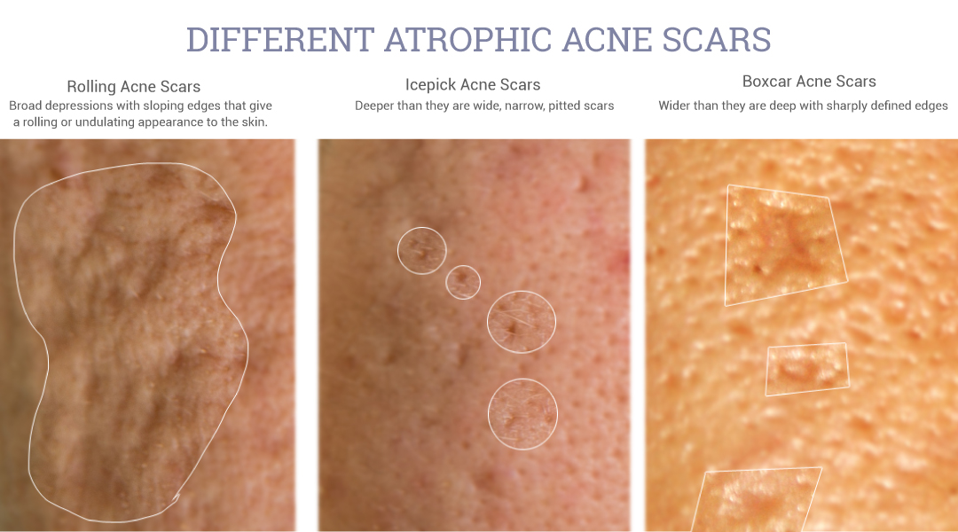 Adapalene 0.3% may help improve the appearance of atrophic acne scars